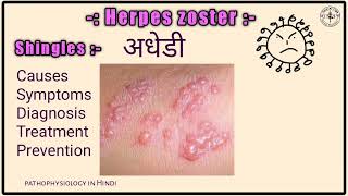 अधेडी  What is Herpes Zoster  Shingle  अधेड़ी का घरेलू उपचार  Herpes Zoster causes treatment [upl. by Attennaej641]