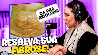 VEJA COMO MELHORAR A FIBROSE MESMO COM LIPEDEMA [upl. by Anaj747]