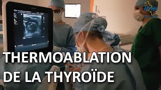 Thermoablation des nodules thyroïdiens par radiofréquence  une nouvelle technique non invasive [upl. by Ilrahs]