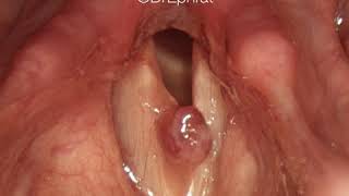 Vocal Cord Polyp [upl. by Daniell]