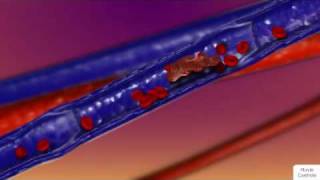 How Blood Clots Form [upl. by Reinald164]