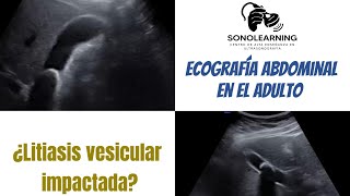 Litiasis vesicular impactada cursosonline ultrasound ecografia [upl. by Gayner]