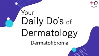 Dermatofibroma  Daily Dos of Dermatology [upl. by Kellsie689]