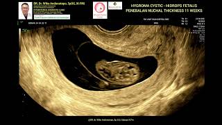 Hygroma Kistik  Hydrops Fetalis  NT Tebal 11 weeks [upl. by Anuaek]