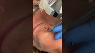 Sciton Profractional Laser Treatment for the face Seriously Skin Cleveland Ohio [upl. by Cy448]