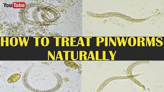 How To Treat Pinworms  Pinworm Treatment Home Remedy  Pictures Of Pinworms [upl. by Nitsyrk921]