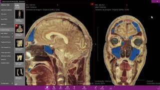 Anatomia Radiológica do Plano esfenoidal [upl. by Triny]