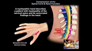 Compression of the Spinal Cord amp Hand Function  Everything You Need To Know  Dr Nabil Ebraheim [upl. by Intihw]