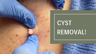 Cyst Removal  Dr Derm [upl. by Primo82]