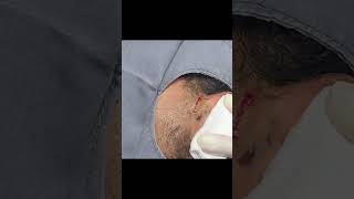 An Ear Cyst You Dont Want to Miss [upl. by Llertnad30]