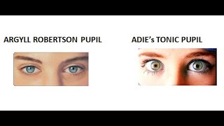 Ophthalmology 326 Argyll robertson pupil Adies tonic pupil neurosyphilis difference pilocarpine test [upl. by Tatia]