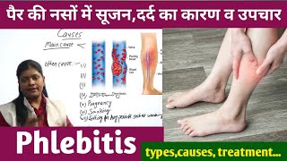 पैर की नसों में सूजन व दर्द का कारण और उपचार  What is Phlebitis types causes symptoms amp treatment [upl. by Yoshi82]