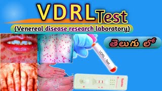 VDRL Test Venereal disease research laboratoryMLTTeluguLabVDRL Test తెలుగు లో [upl. by Alauqahs]