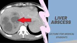 Liver abscess  Lecture for Medical Students mbbs neet usmle fmge neetpg [upl. by Adnawot]