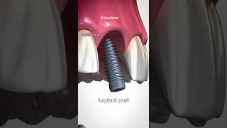 Dental implantsBone Graft dental shorts dentaltreatment twitch youtubeshorts implantfyp [upl. by Necaj]