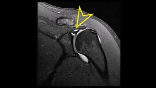 Shoulder MRI Labral SLAP Superior Labrum Anterior Posterior Tear [upl. by Monjo]