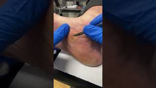 Learn how a Podiatrist expertly removes Medial Foot Callus Removal  Corn and Callus Treatment [upl. by Doi719]