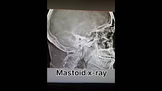 mastoid x ray ear x ray radiology shortvideo [upl. by Etnovad393]