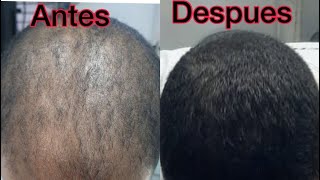 Minoxidil para Crecer Barba y Pelo [upl. by Guyer]