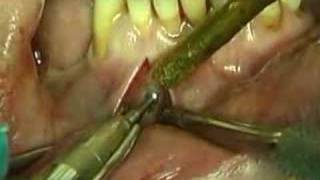 implant dental video preview 13 [upl. by Iggie]