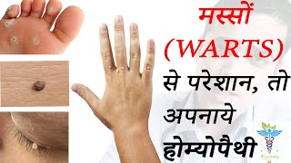 How to Remove WartsGenital Warts  BEST HOMEOPATHIC MEDICINES IN 2020 मस्से [upl. by Etak]