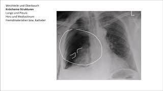 Röntgen Thorax Befundung [upl. by Feodora]