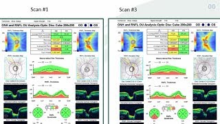 10 Hacks for OCT Interpretation in Glaucoma  Dr Mark Dunbar [upl. by Rentschler]