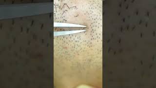 ingrown hair pull out speedx2 with tweezers Satisfying 274 satisfying well removal [upl. by Lavicrep]