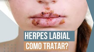 Herpes labial  Como previnir e tratar [upl. by Tigirb]