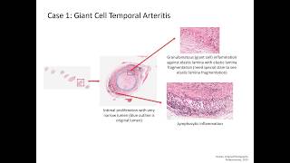 LG30 Vasculitis Patient Scenario with Slide Review 10 Min [upl. by Anaya426]