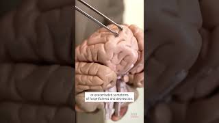 Live Parasitic Worm Removed From Woman’s Brain shorts [upl. by Lonny122]