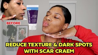 Mederma Cream for Acne Scars  My 2 Week Transformation [upl. by Judson]