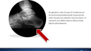 Origine de lépine de Lenoir ou lépine calcanéenne [upl. by Nnayt]