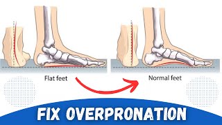 How to Correct Overpronation Fallen Arches [upl. by Curkell]