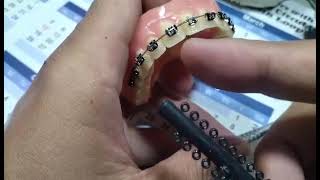 Pustiso may Braces pustiso with braces Pwede Ba by DatuAmbasTv [upl. by Hausmann603]