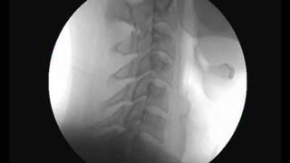 Cervical Spine Video Fluoroscopy  Chiropractic Care [upl. by Joscelin610]