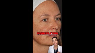 Do you know the most common triggers for melasma🌞  Join me as I delve into the factors that [upl. by Ynnavoeg57]