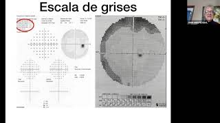 Bases de campimetría [upl. by Cave]