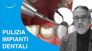 Come gli pulire impianti dentali  Prof Makarati a Dica33  Telearena [upl. by Farny477]