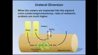 Normal Anion Gap Metabolic Acidosis ABG Interpretation  Lesson 9 [upl. by Anires317]