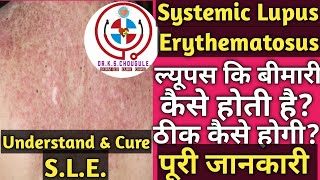 Systemic Lupus Erythematosusलूपस कि बीमारी क्या होती हैAutoimmune diseases कैसे होते है100Info [upl. by Gris737]