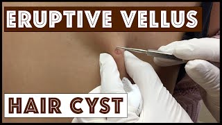 Unusual types of Cysts Eruptive Vellus Hair Cysts Part 1 in a Series [upl. by Akenet]