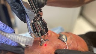 PROFRACTIONAL LASER FOR ACNE SCARS [upl. by Annaet726]