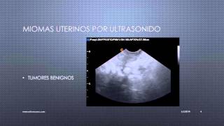 MIOMAS UTERINOS VISUALIZADOS POR ULTRASONIDO [upl. by Akinej]