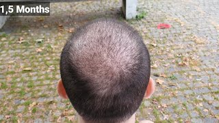 FUE Hair Transplant Timeline I Day 1 to Day 365 I Before amp After [upl. by Markson]