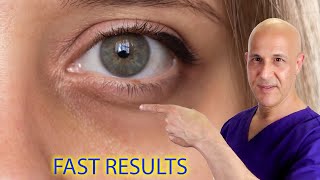 DIY Get Rid of Dark Circles and Wrinkles Under Eyes Naturally [upl. by Gardener]