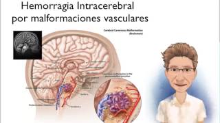 HEMORRAGIA INTRACEREBRAL CONCEPTO Y CLASIFICACIÓN [upl. by Yeclek]