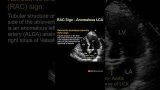 RAC Sign of Anomalous LCA echocardiography cardiology science [upl. by Niemad]