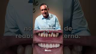 Análise de Caso Real Reabilitação Dental com Implantes [upl. by Madella]