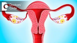 Can Polycystic Ovaries cause high prolactin amp androgen levels  Dr Anjana Ramesh [upl. by Oiuqise]